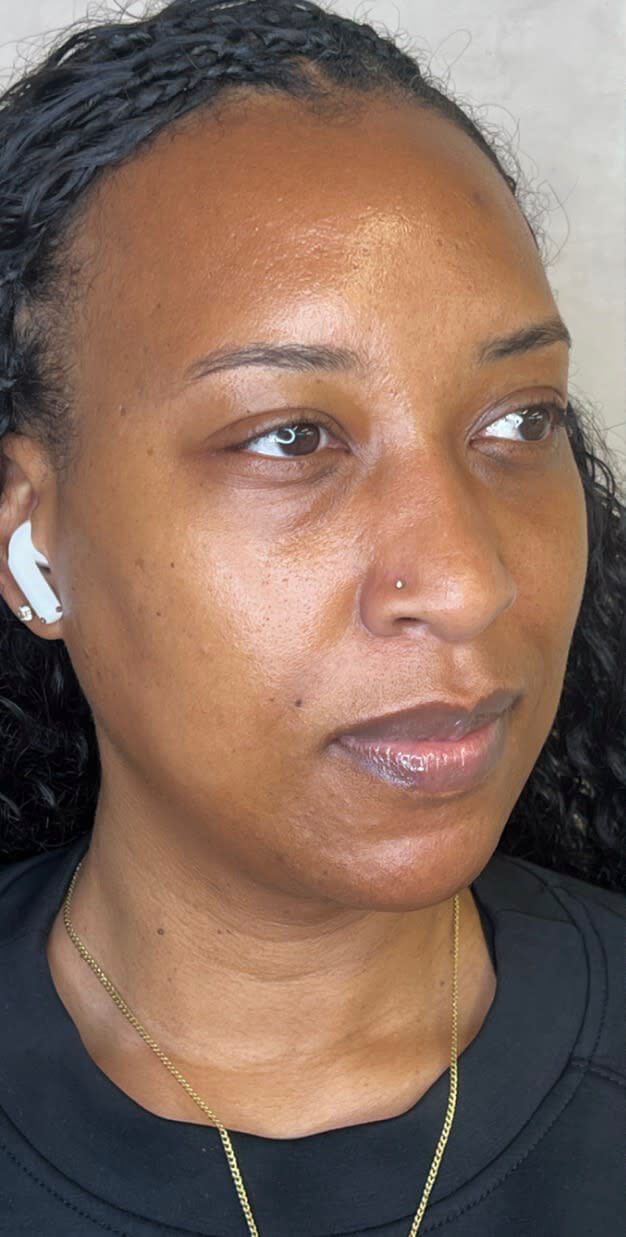 Dermal Fillers image – Before Dermal Fillers image - Before